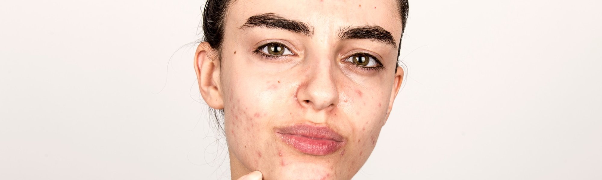 Pele acneica em garota que aponta para seu rosto com a pele com acne